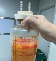 益阳水动力吸脂手术要做多久？